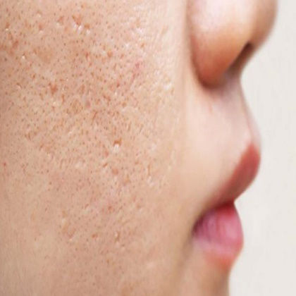 درمان خانگی برای منافذ باز پوست صورت